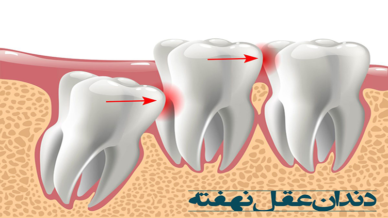 بهترین دندانپزشک اصفهان | دندان عقل چیست