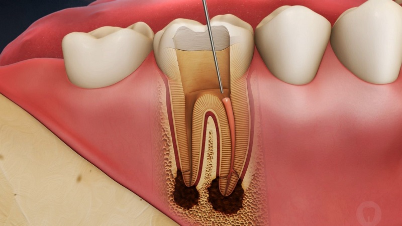 چه زمانی به درمان ریشه دندان نیاز داریم ؟
