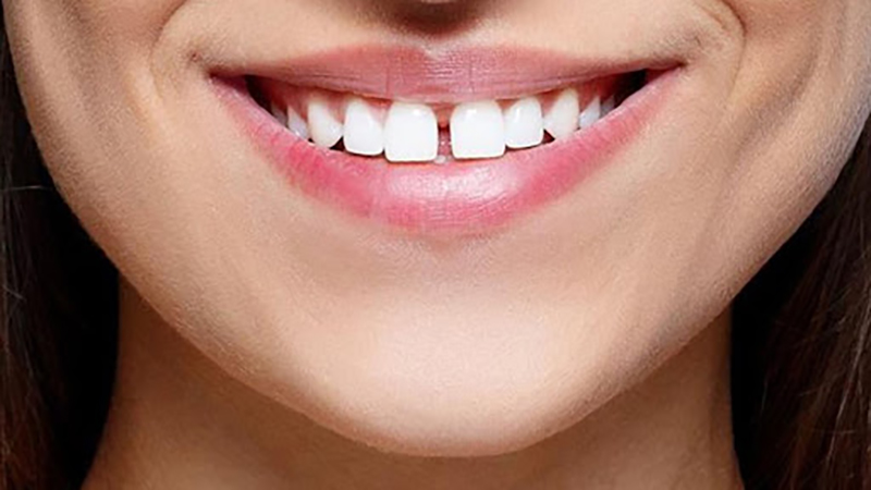 بهترین دندانپزشک اصفهان | بستن فاصله بین دندان