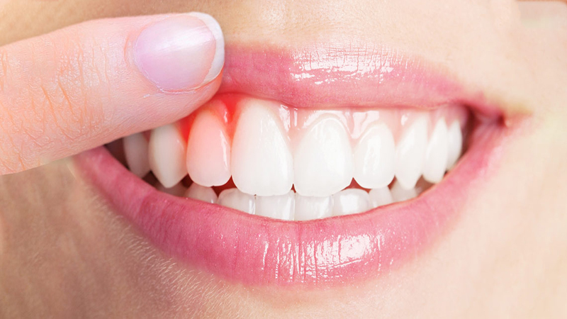 بهترین دندانپزشک اصفهان | بیماریهای لثه در کودکان