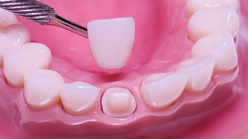 بهترین دندانپزشک اصفهان | عوارض احتمالی روکش کردن دندان