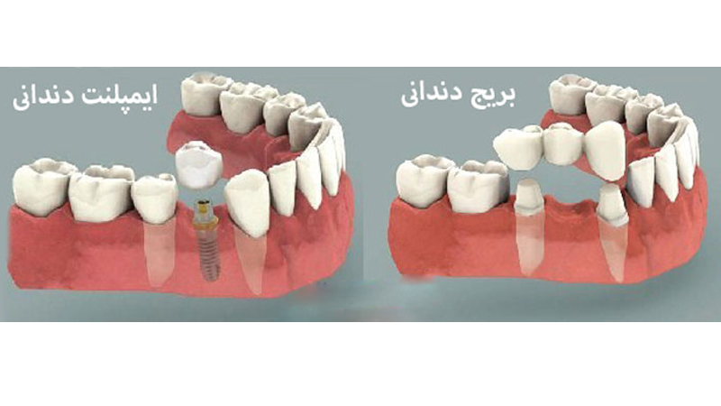 بهترین دنداپزشک اصفهان | معرفی روش ایمپلنت و بریج دندان