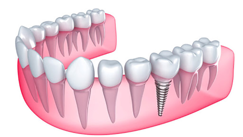 بهترین دندانپزشک اصفهان | چه کسانی نباید ایمپلنت دندان انجام دهند