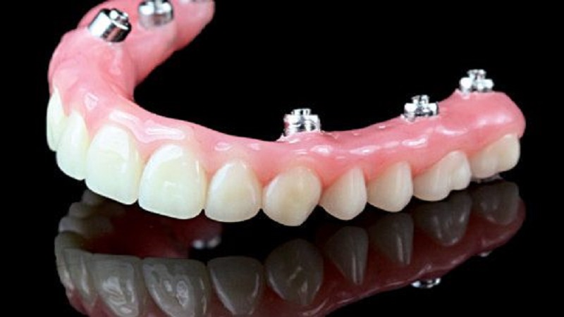 بهترین دندانپزشک اصفهان | پروتز ثابت دندان