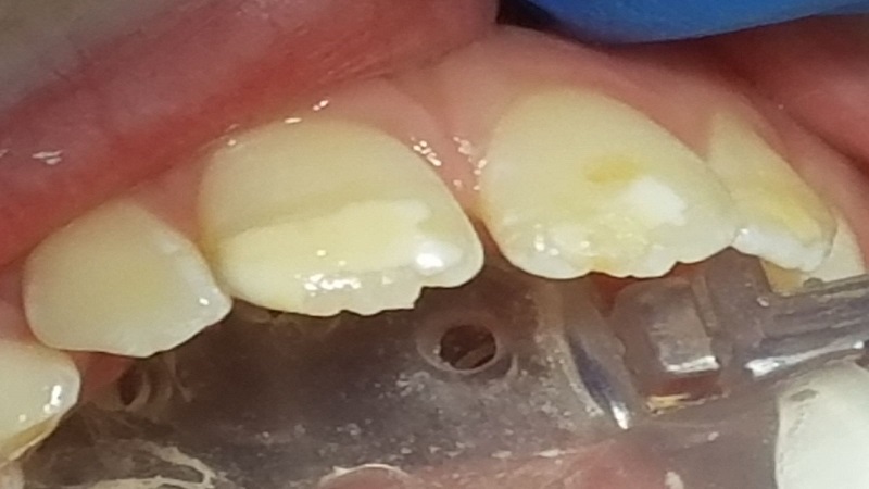 بهترین دندانپزشک اصفهان | جرم دندان چیست ؟