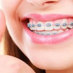 بهترین دندانپزشک اصفهان | مزایا و معایب ارتودنسی ثابت